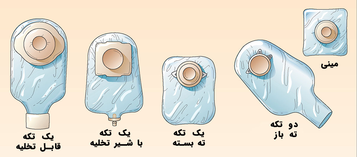 کیسه کلستومی