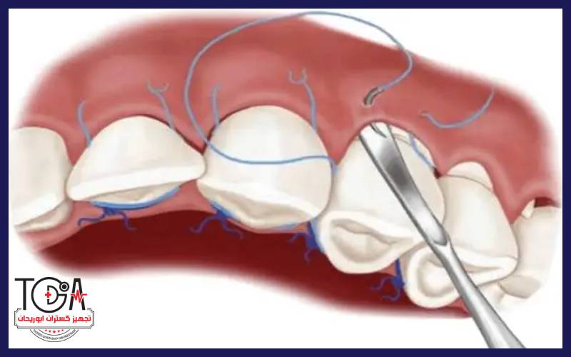 کشیدن بخیه دندان 